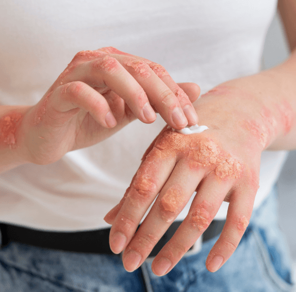Skin Disorders